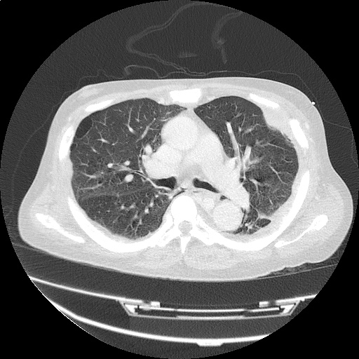 ct_chest_anemia_13